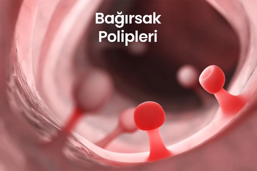 Bağırsak Polipleri