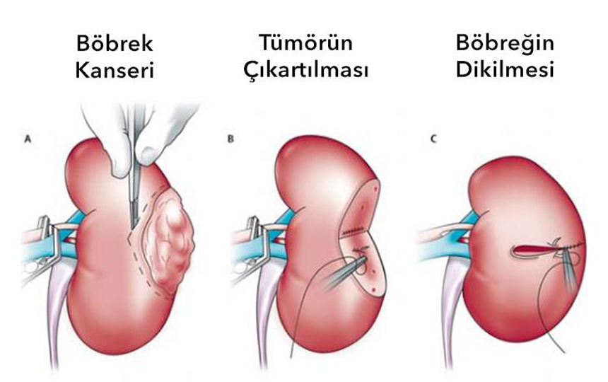 Böbrek Kanseri