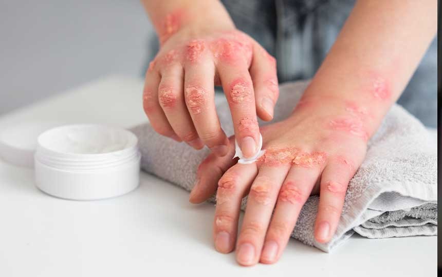 Kontakt dermatit nedir?