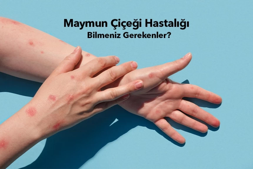 Maymun Çiçeği Hastalığı Bilmeniz Gerekenler?