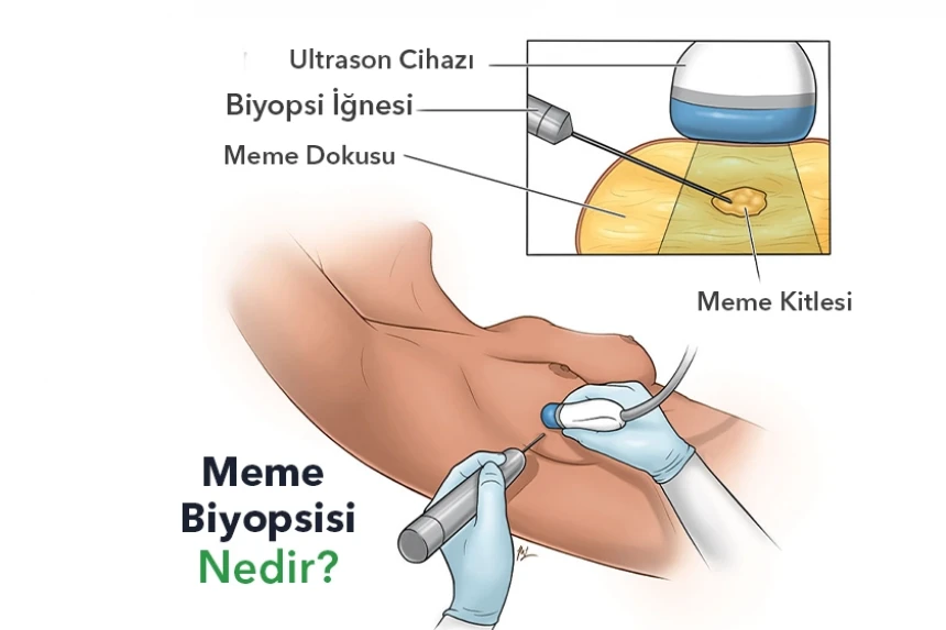 Meme Biyopsisi Nedir?