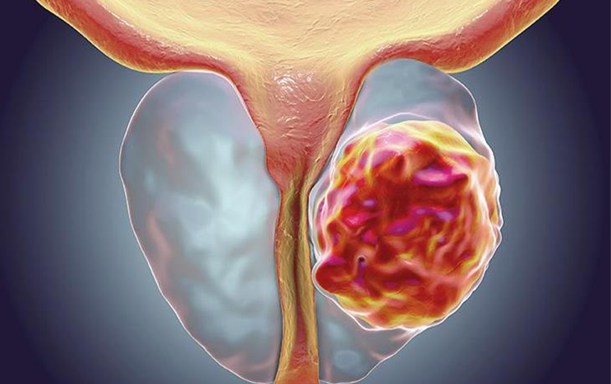 Prostat Kanseri - Ersoy Hastanesi