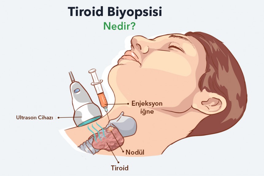 Tiroid Biyopsisi Nedir?